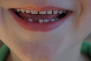 Child with missing tooth smiling