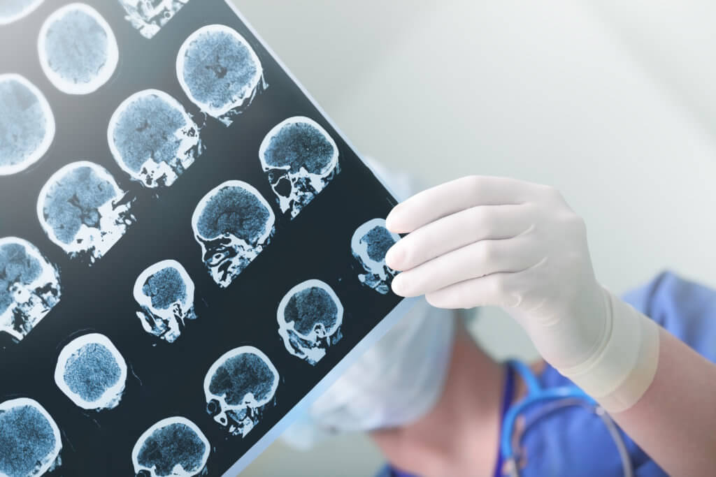 Doctors looking at brain imaging scans