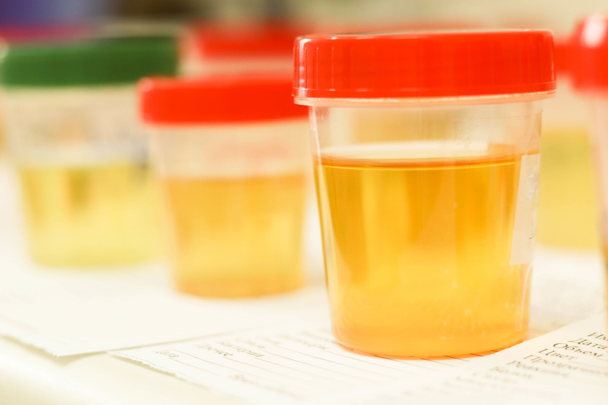 New urine test can predict onset of bladder cancer years before symptoms appear