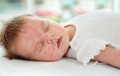 Baby with eczema or skin rash