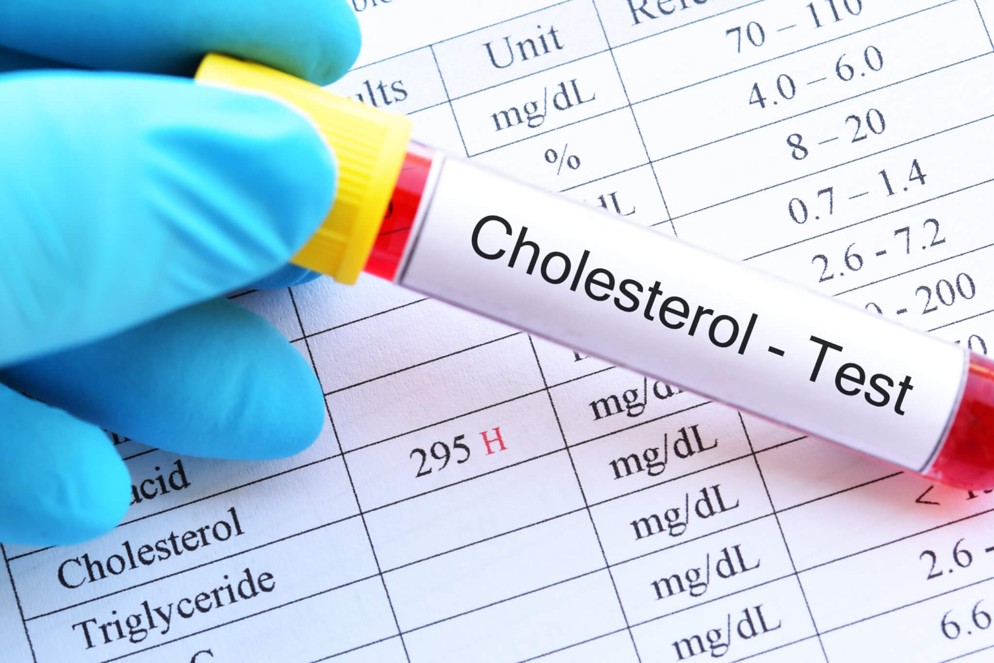 Cholesterol test -- results show high cholesterol