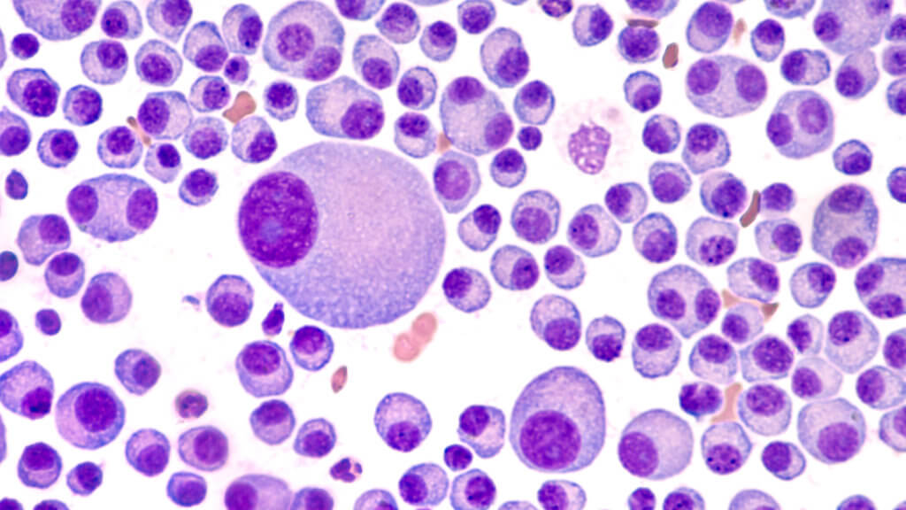 Bone marrow cancer cells - multiple myeloma