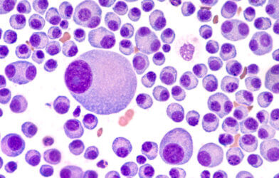Bone marrow cancer cells - multiple myeloma