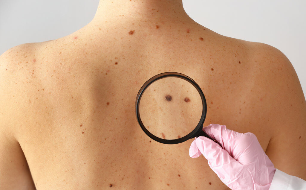 Mole on woman's back as doctor checks for skin cancer