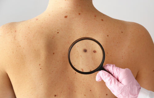 Mole on woman's back as doctor checks for skin cancer