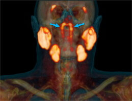 Cancer scan glands