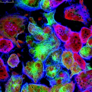 Breast Cancer Cells