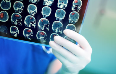 Brain tumor seen in brain scan