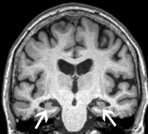 Brain scan dementia