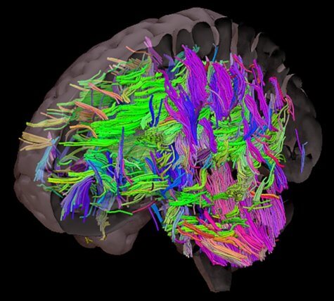 obesity MRI brain scan