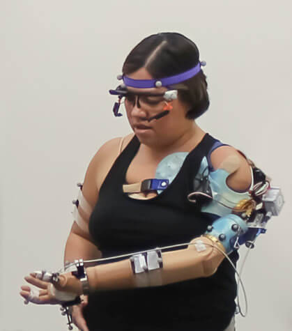 Bionic arm patient