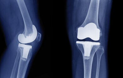 X-ray image of total knee arthroplasty / total knee replacement