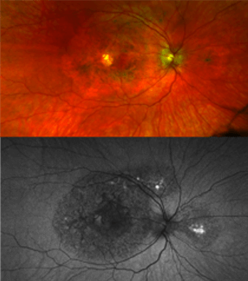 TIMP3 retinopathy