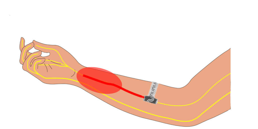 Arm implant illustration