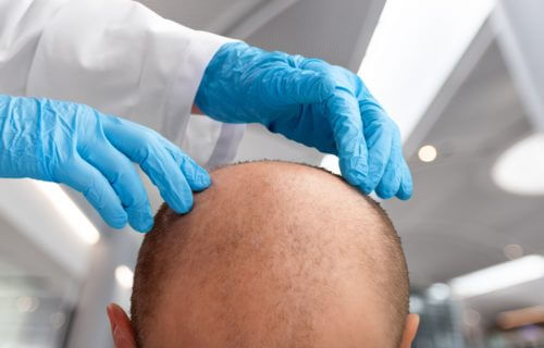 Baldness: Doctor looking at bald man's head
