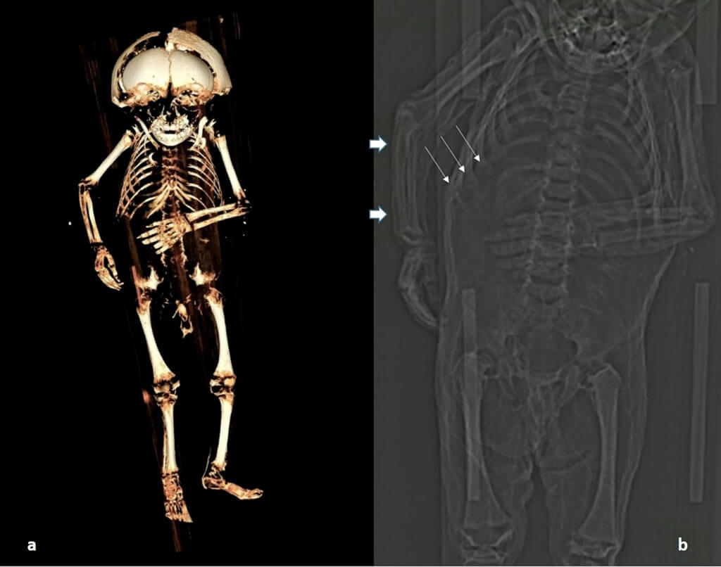 CT Scan Of Child Mummy