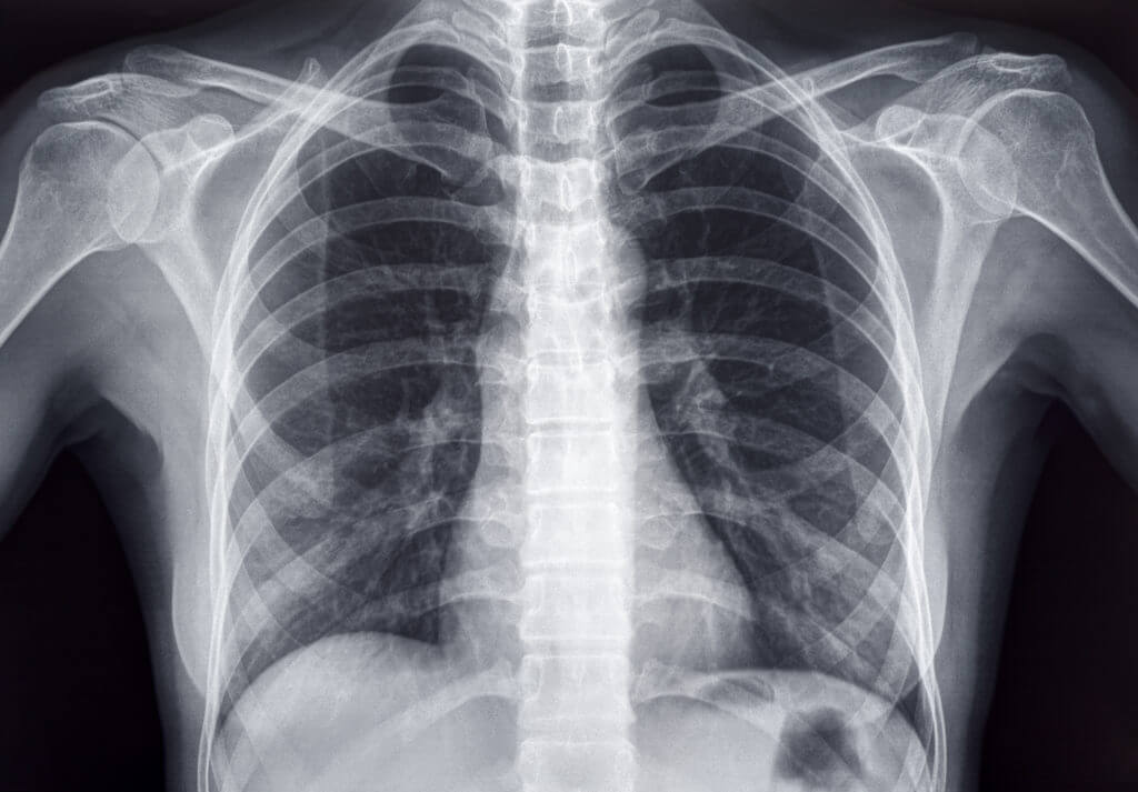 Chest x-ray of an adult female human