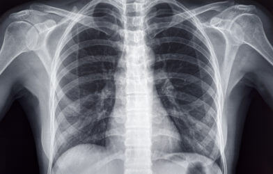 Chest x-ray of an adult female human