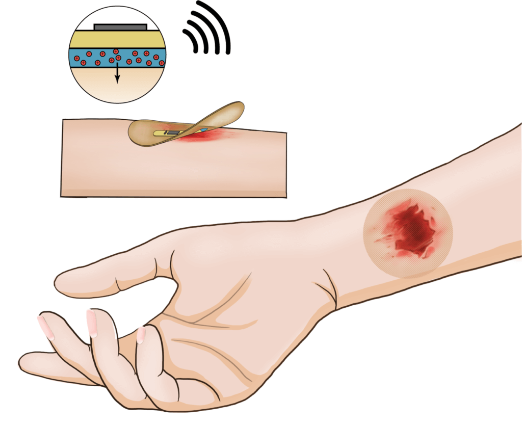 Wireless smart bandage