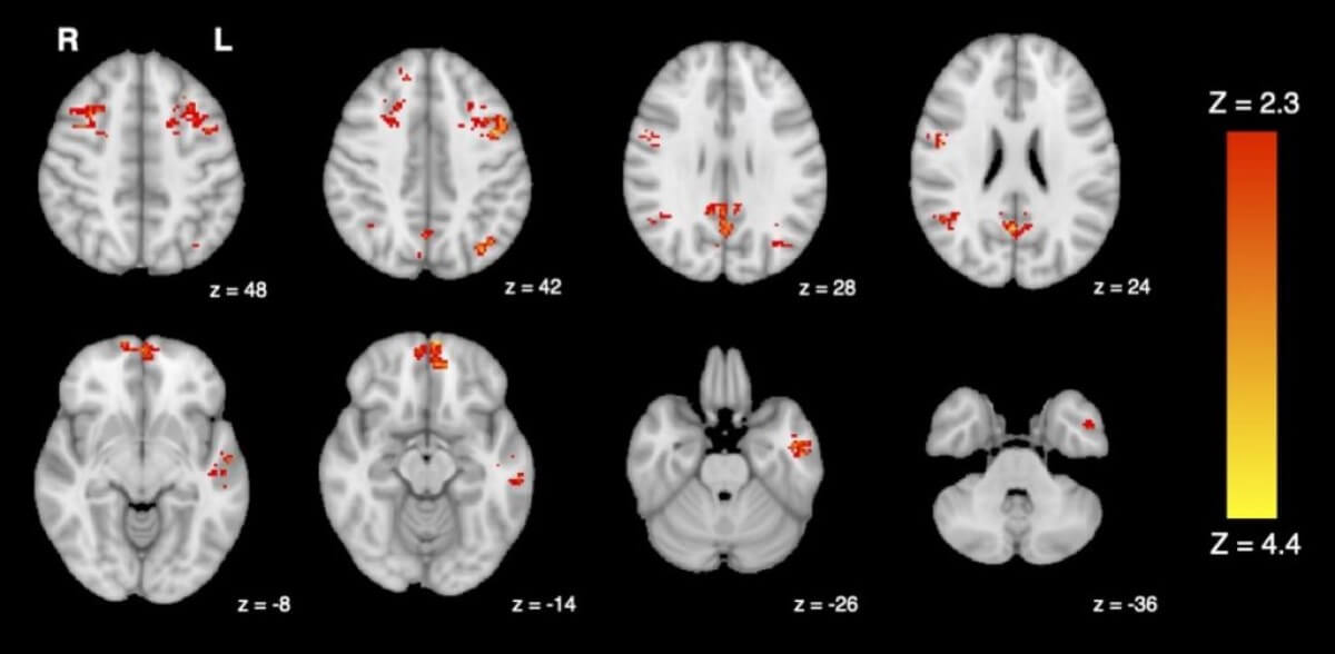 Collection of brain scans showing decreased activity