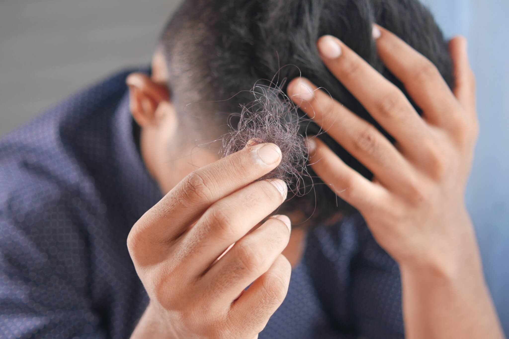 Person losing hair, hair loss