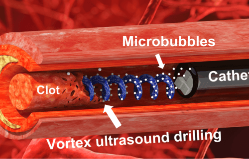 Illustration of a “vortex ultrasound” – a sort of ultrasonic tornado – to break down blood clots.