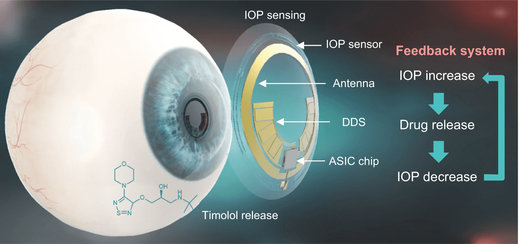 Schematic illustration of a theranostic smart contact lens for glaucoma treatment.