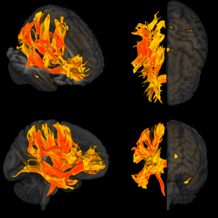 3d red and yellow image of blood pressure in brain, mental decline