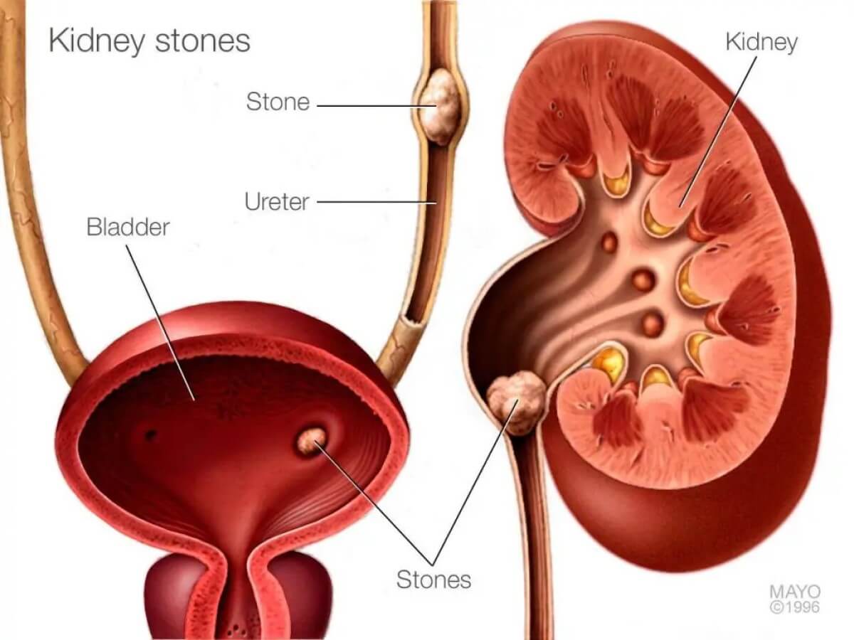 kidney stone diagram