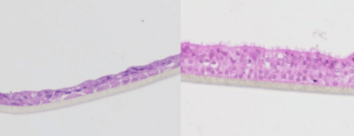 Diseased lung slice compared to a healthy lung