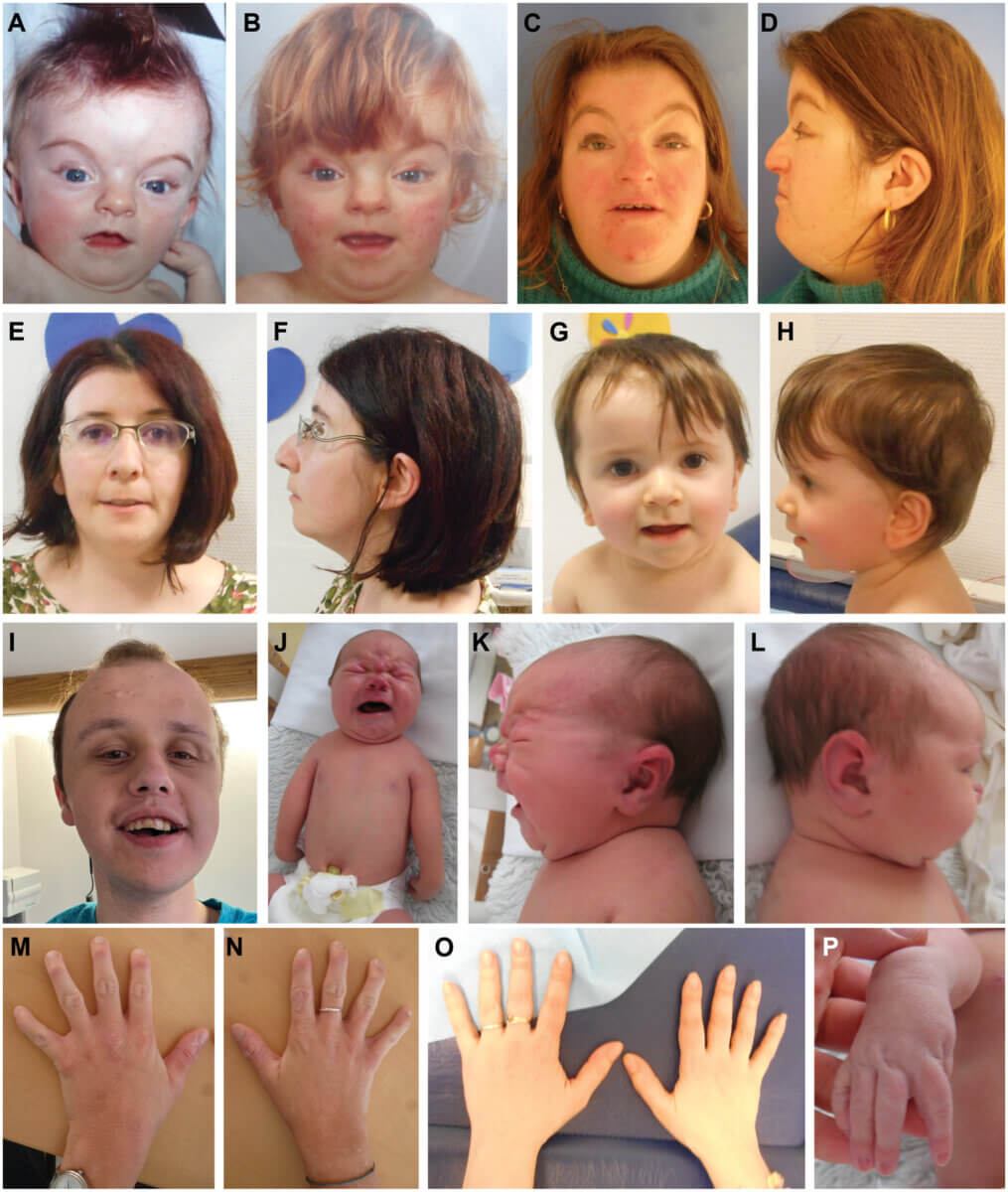 Fig. 2. Affected individuals display CFAs and limb abnormalities. (A to D) Affected individual at the age of 4 months (A), 14 months (B), and 28 years (C and D). Individual displays ptosis, high arched eyebrows, broad nasal root, thin lips, and posteriorly rotated ears. (E to H) Affected mother at 29 years of age (E and F) and her affected child (G and H) at 11 months of age. Individuals display down-slanting palpebral fissures, low-set ears, and thin upper lip. (I) Affected individual at 18 years of age. Individual displays high anterior hairline, ptosis, and down-slanting palpebral fissures. (J to L) Affected infant displays asymmetric crying facies, wide and flat nasal bridge, posteriorly rotated ears, as well as shoulder, hand, and elbow malformations. (M to P) Affected individuals display limb abnormalities including brachydactyly (M to O) and wrist contractures (P).