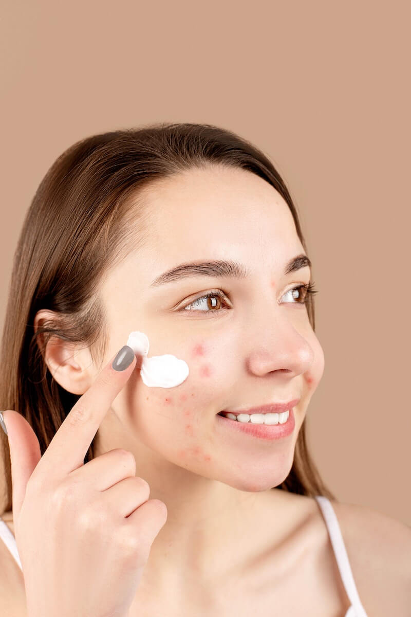 A girl applying acne spot treatment