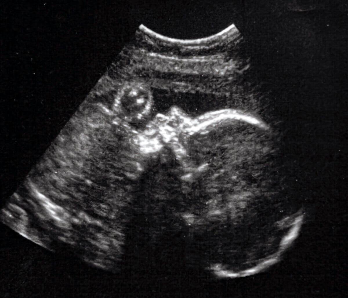 Ultrasound of a healthy baby in-utero. 