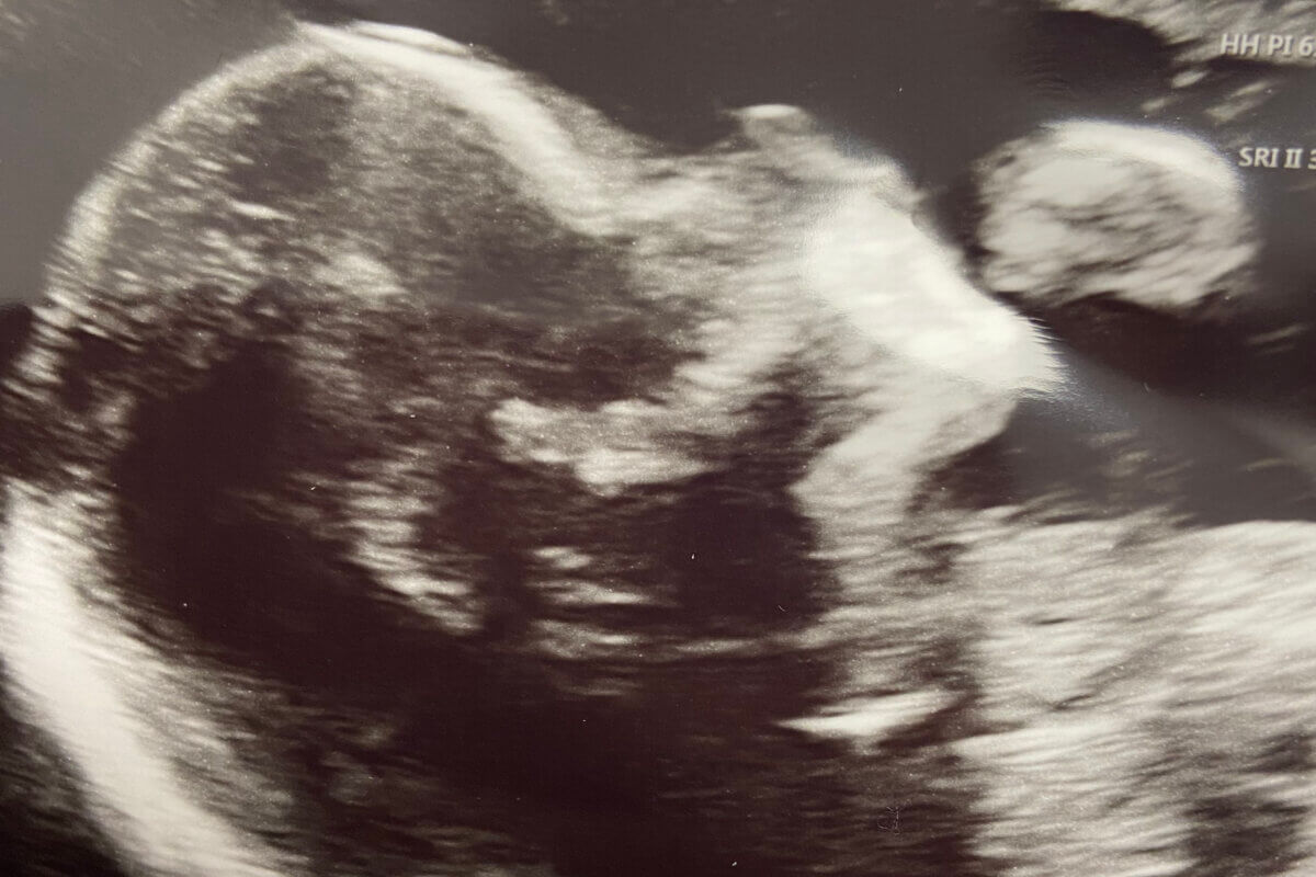 Scans showed Sarah’s unborn baby wriggling her legs in the womb.