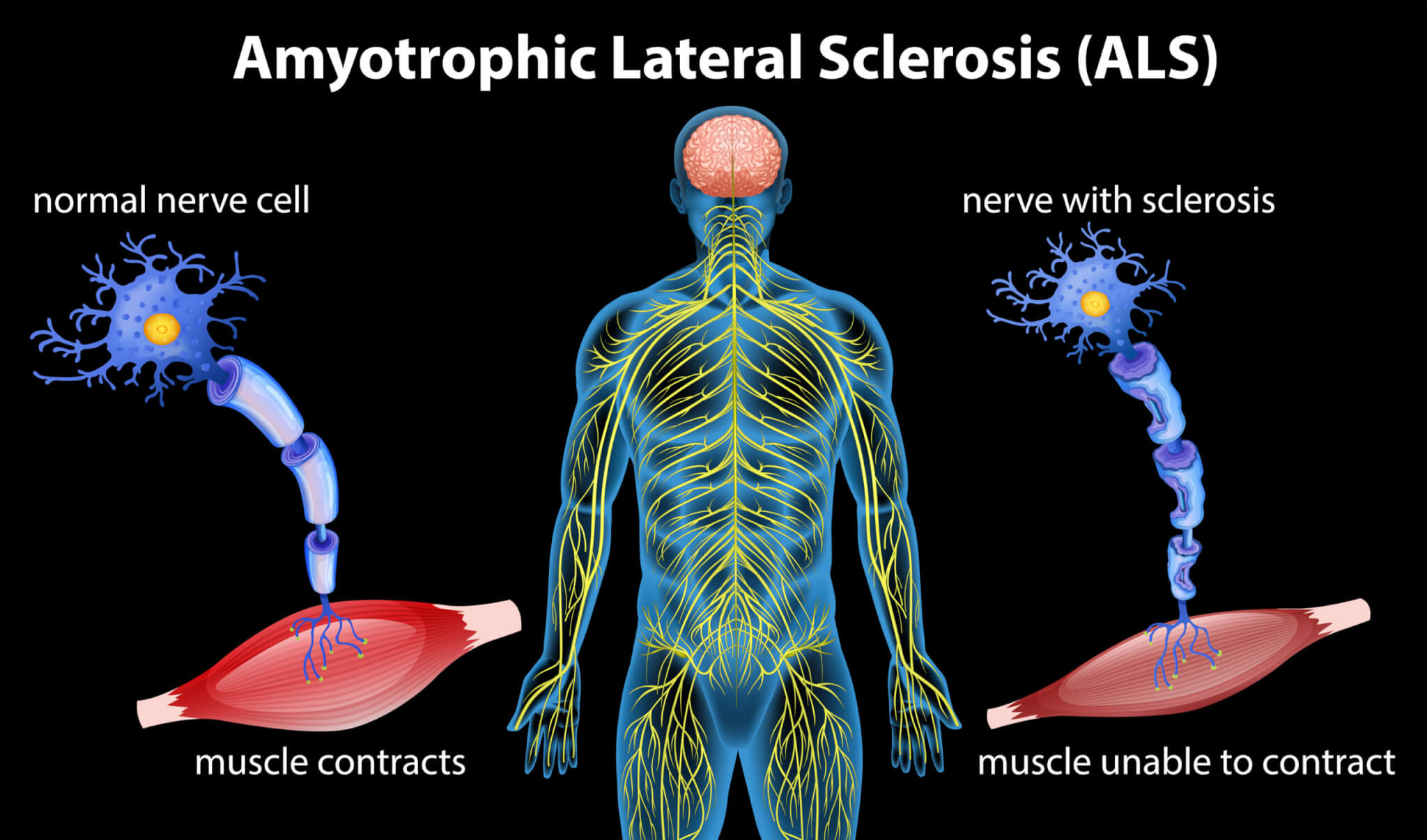 Anatomy of amyotrophic lateral sclerosis
