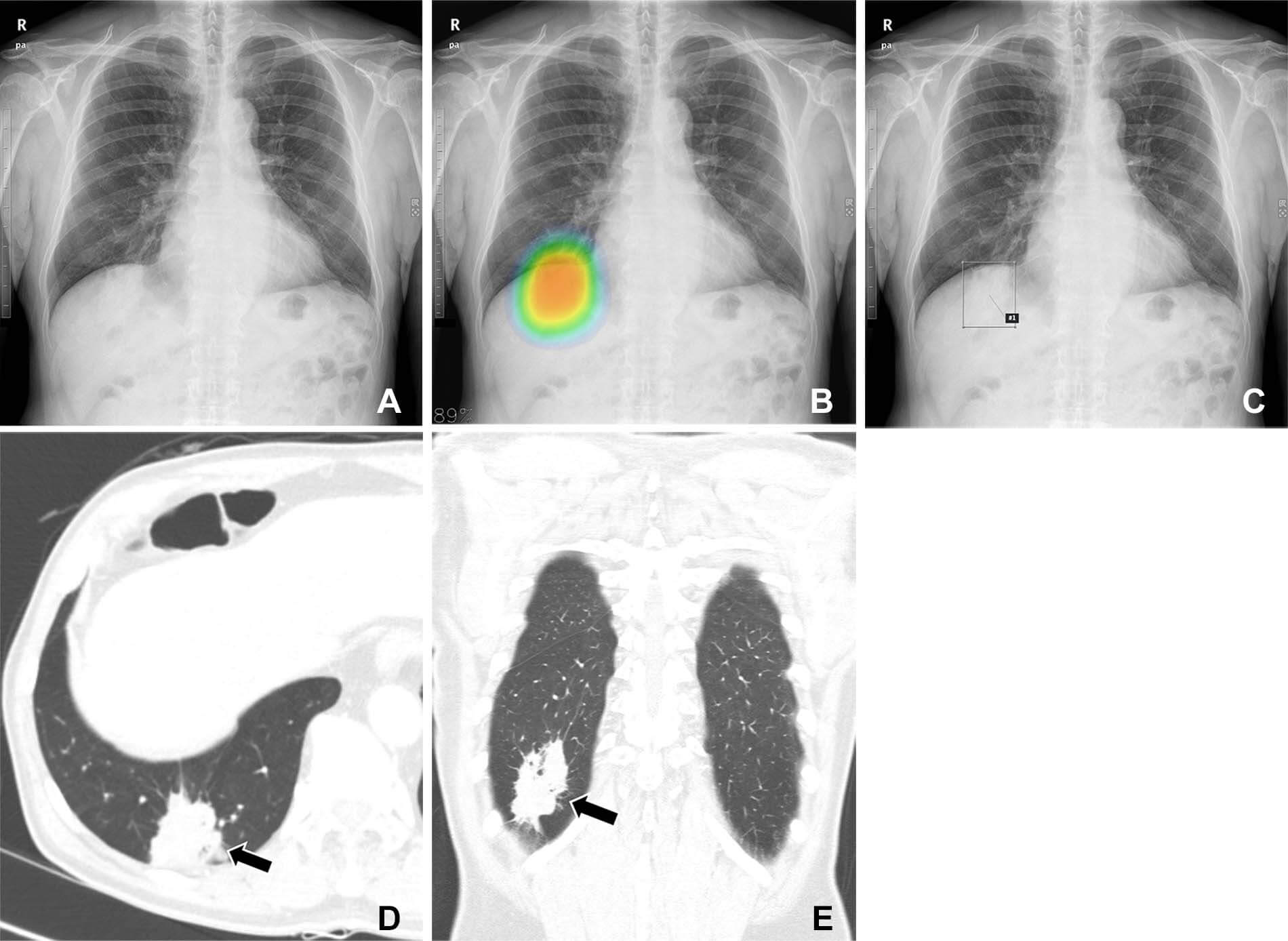 Chest radiographs obtained as part of a health checkup in a 71-year-old male patient show reader susceptibility to high diagnostic accuracy artificial intelligence (AI).
