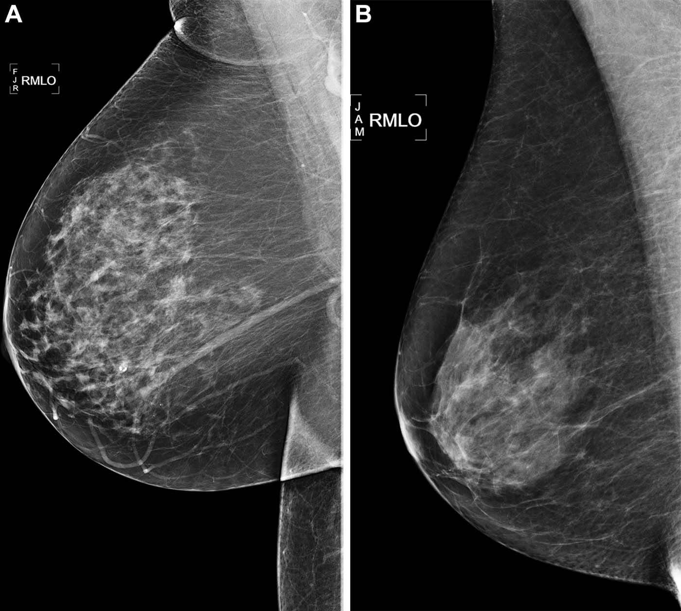 mammogram scans detecting breast cancer