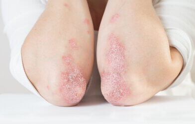 Acute psoriasis on the elbows is an autoimmune incurable dermatological skin disease.