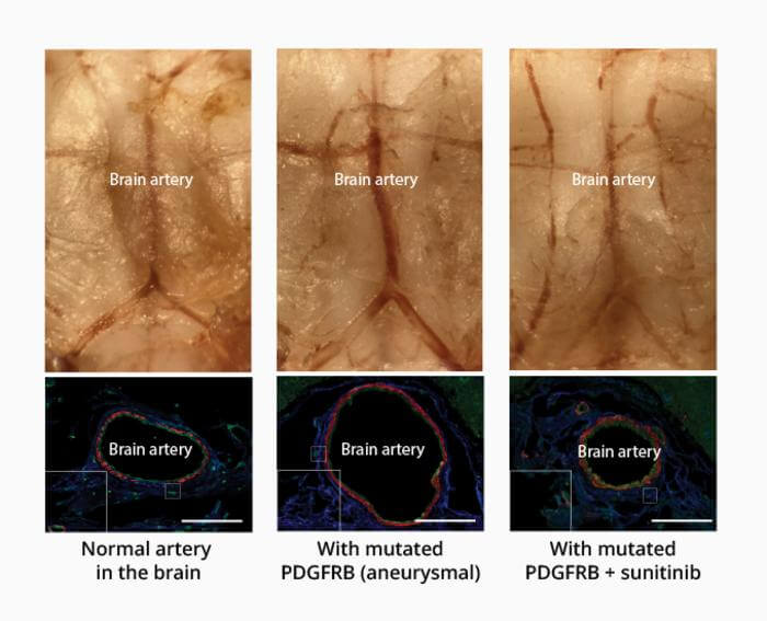 aneurysm drug's effect on brain arteries