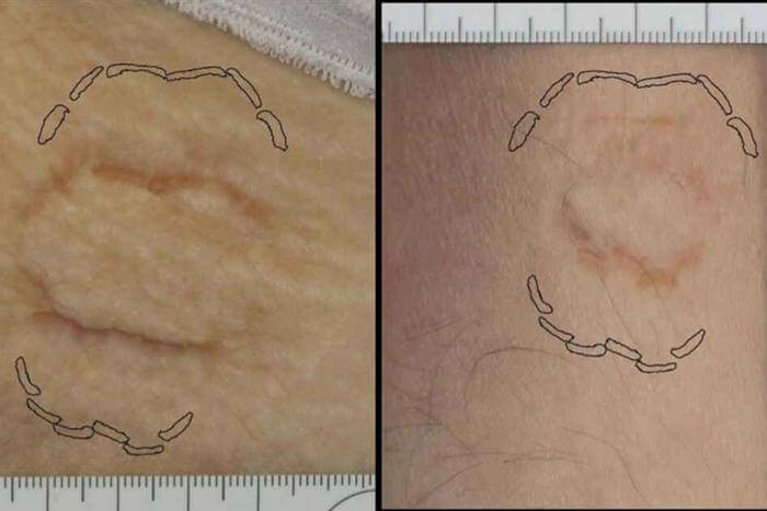 two pics of bite marks on the skin of two different people