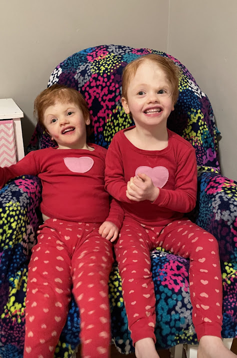 conjoined twins Abby (left) and Erin (right). 