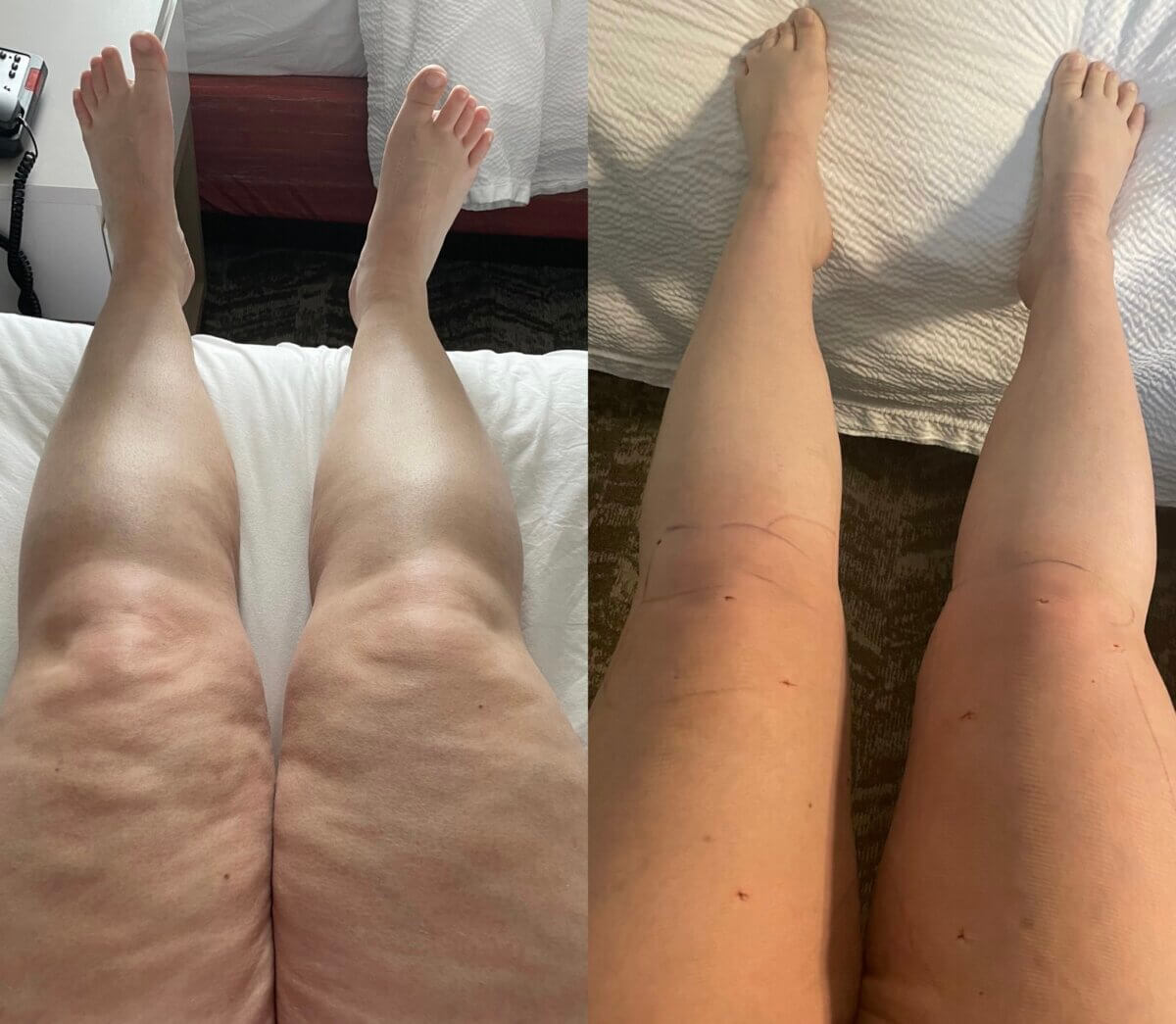 Patient with lipedema shows changes in her legs.