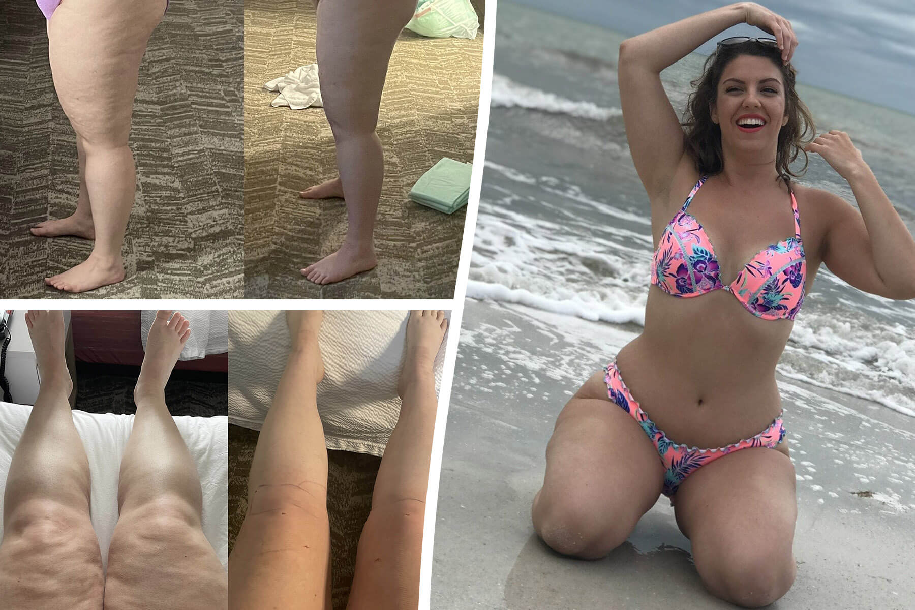 Curvy' woman has 6.5 liters of fluid drained after discovering she had rare  condition on  - Study Finds