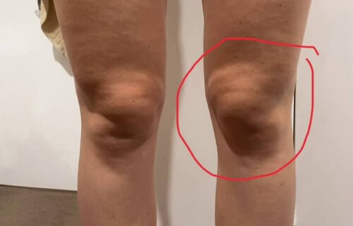 Amy Haigh's knees after having pain at the gym