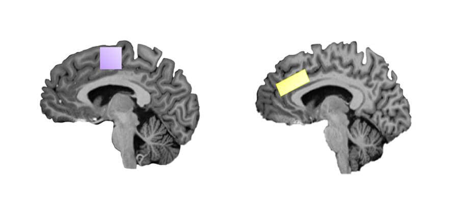 OCD brain scans