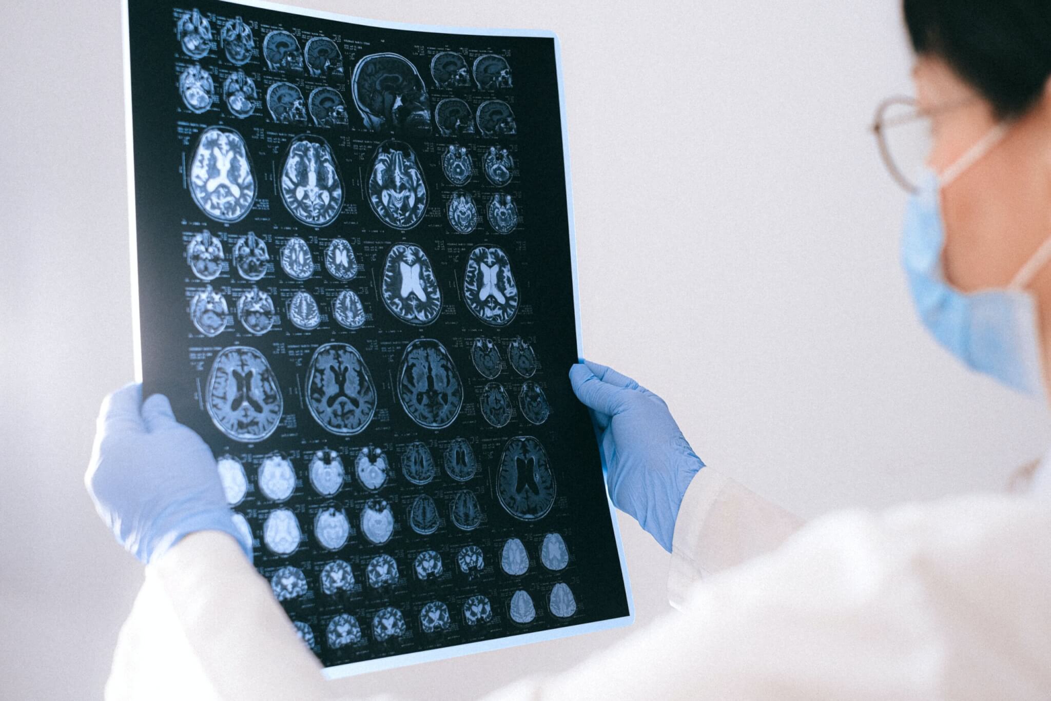 Picture of a doctor holding an MRI image of the brain.