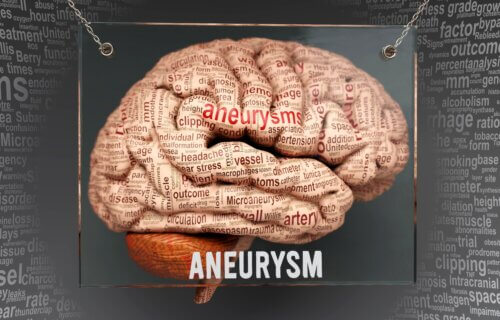 Aneurysm anatomy on a human brain