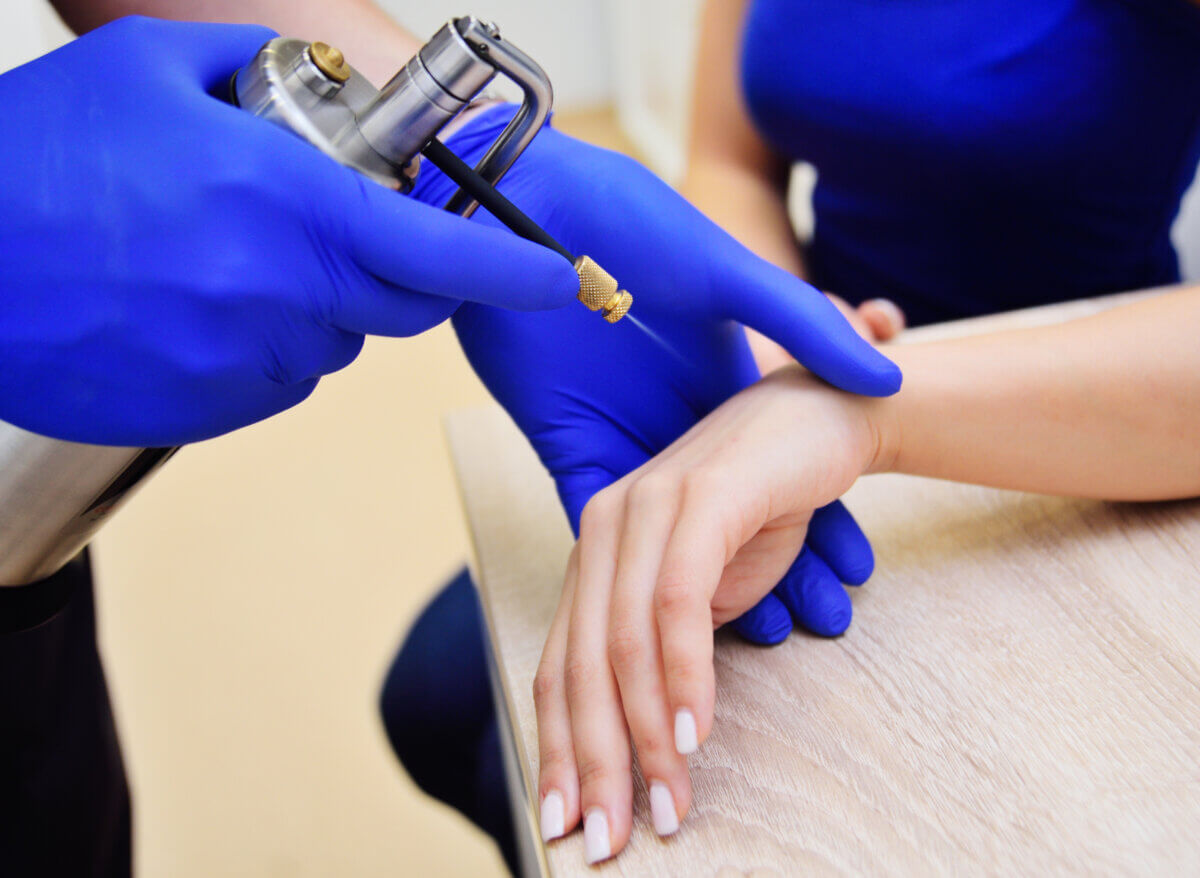 Cryotherapy-cold treatment by a dermatologist on a woman's hand