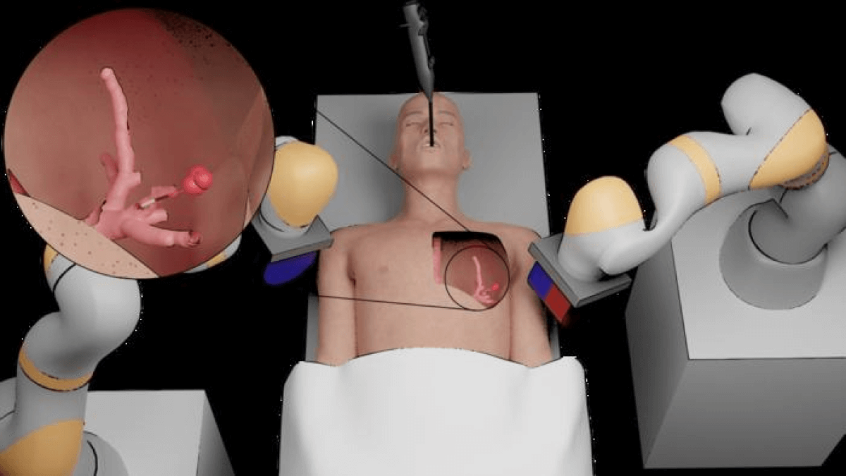 Robotic platform for peripheral lung tumor intervention based on magnetic tentacles.
