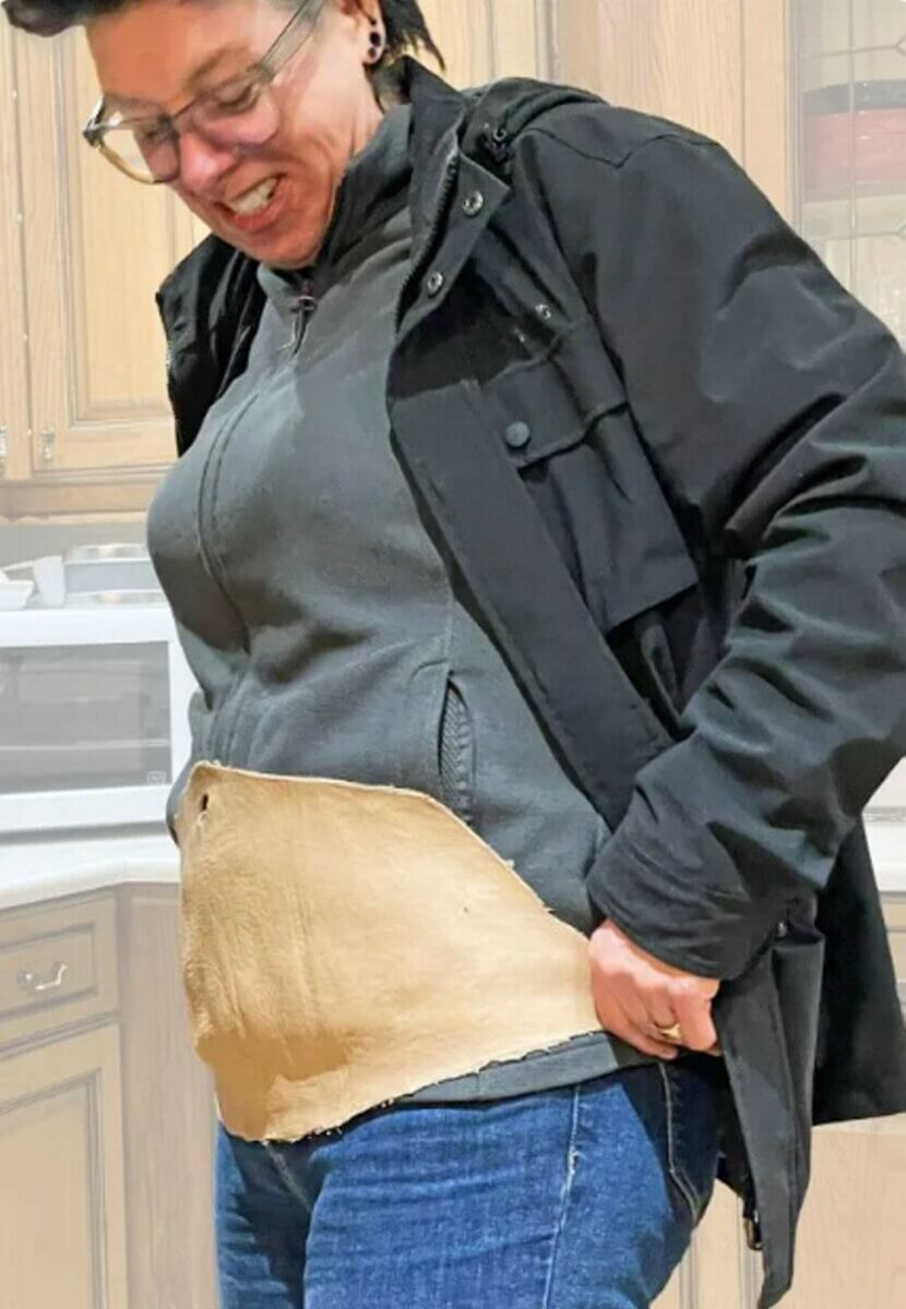 Katie with the removed skin after her weight loss surgery.